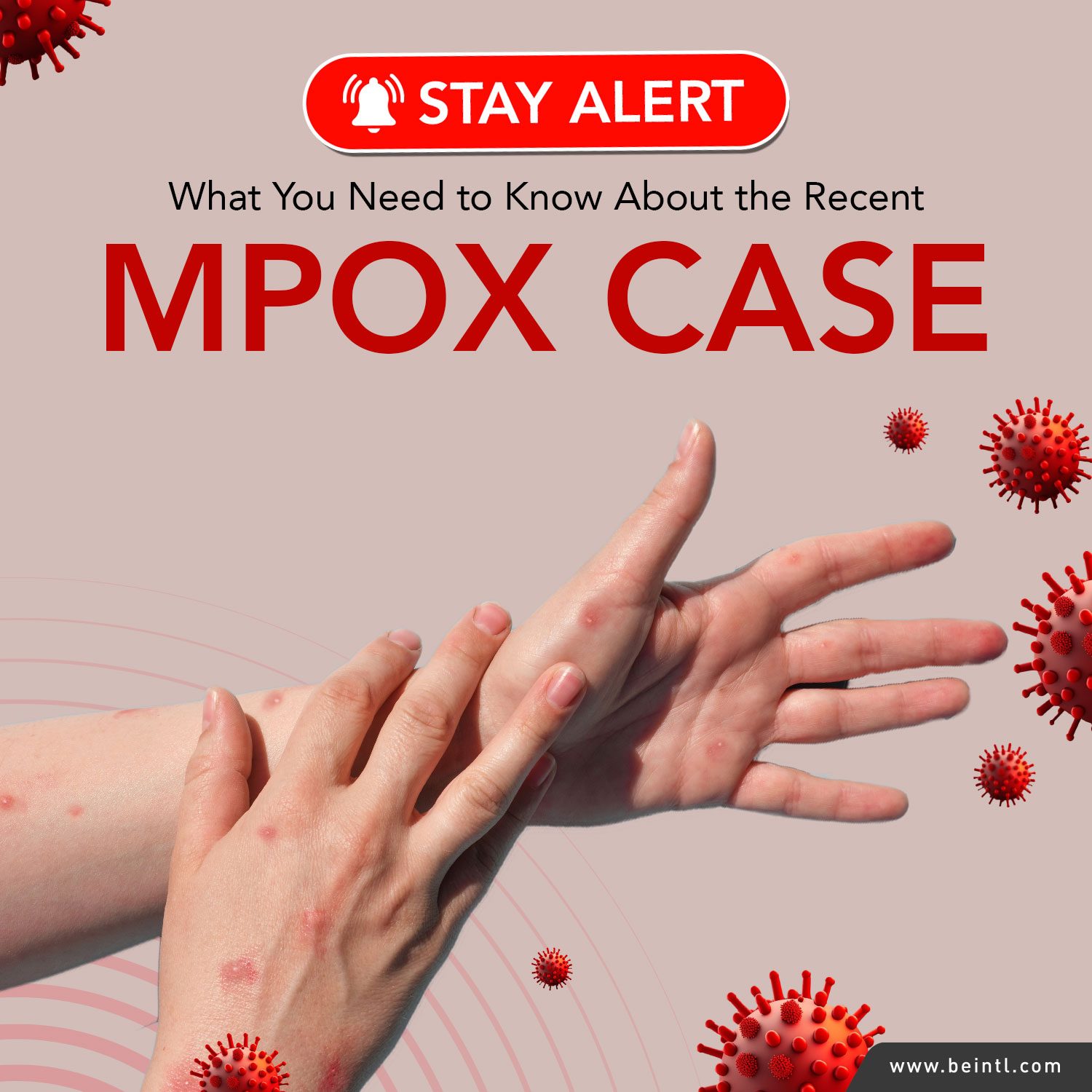 STAY ALERT: What You Need to Know About The Recent Mpox Case in Malaysia